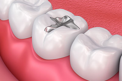 Gentle Breeze Family Dentistry | Gingivitis, Botox reg  and E4D