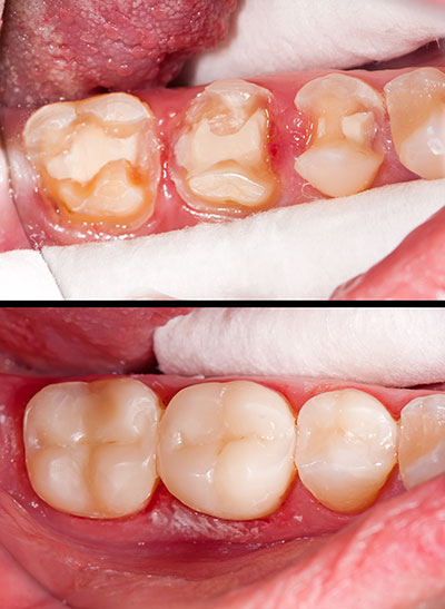 Gentle Breeze Family Dentistry | Preventative Program, Emergency Treatment and Dental Cleanings