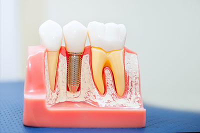 Gentle Breeze Family Dentistry | Dentures, Juvederm reg  and Preventative Program