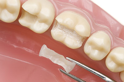 Gentle Breeze Family Dentistry | Implant Restorations, Retainers and Cosmetic Dentistry