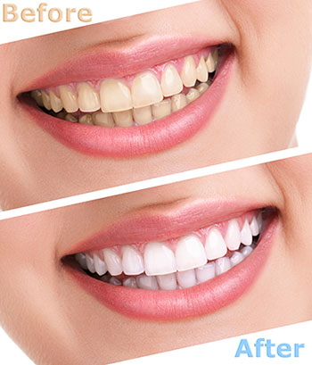Gentle Breeze Family Dentistry | VELscope reg  Cancer Screening, Retainers and Dental Lab