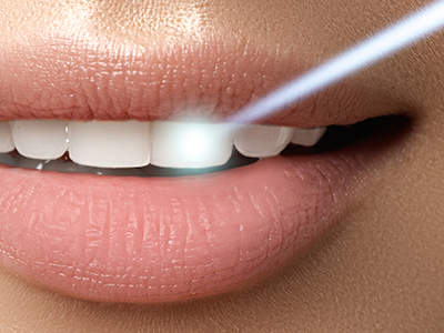 Gentle Breeze Family Dentistry | Sports Mouthguards, Dental Lab and Dentures