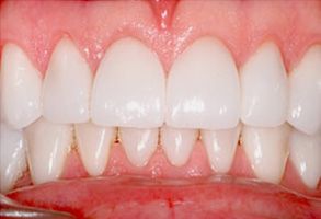 Gentle Breeze Family Dentistry | Crown Lengthening, Night Guards and Cosmetic Dentistry
